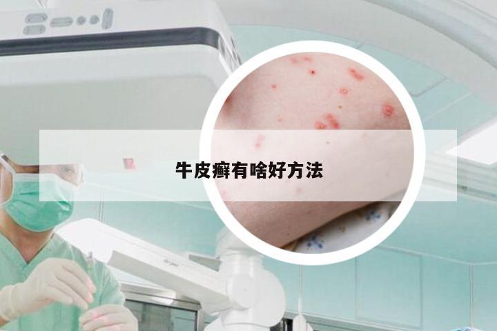 牛皮癣有啥好方法