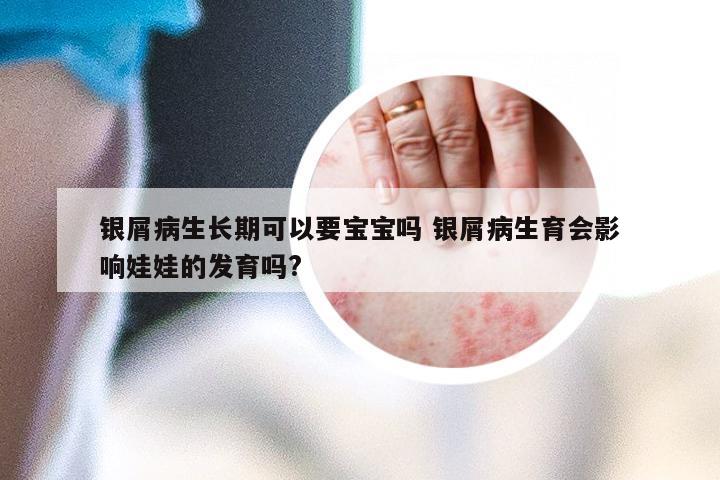 银屑病生长期可以要宝宝吗 银屑病生育会影响娃娃的发育吗?