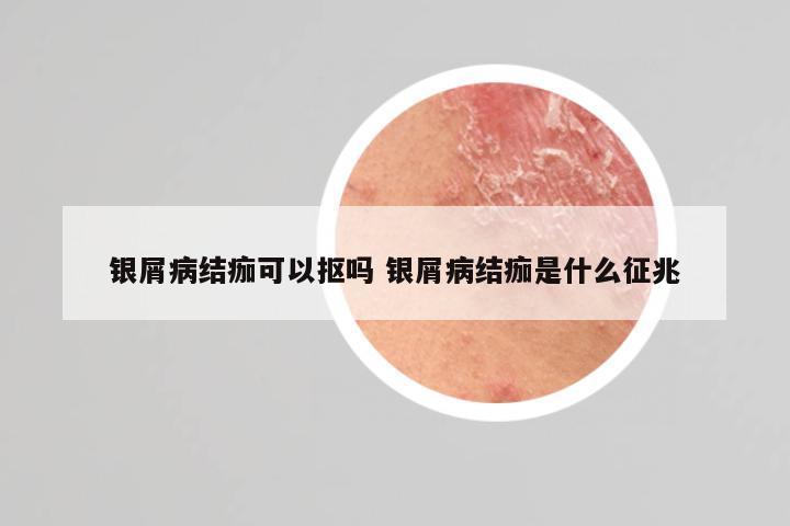 银屑病结痂可以抠吗 银屑病结痂是什么征兆