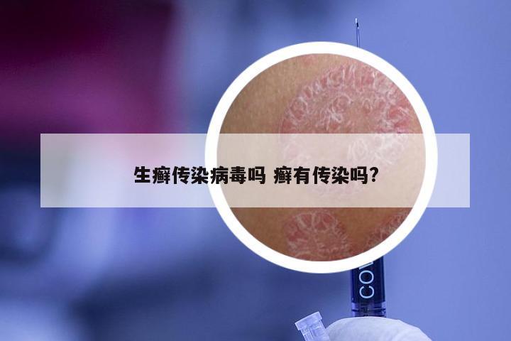 生癣传染病毒吗 癣有传染吗?
