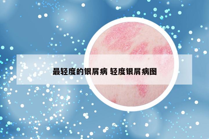 最轻度的银屑病 轻度银屑病图
