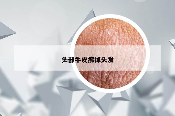 头部牛皮癣掉头发
