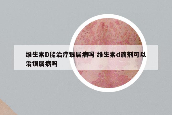 维生素D能治疗银屑病吗 维生素d滴剂可以治银屑病吗