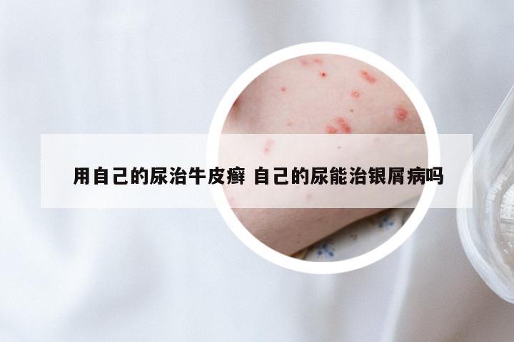 用自己的尿治牛皮癣 自己的尿能治银屑病吗