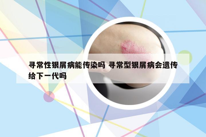 寻常性银屑病能传染吗 寻常型银屑病会遗传给下一代吗