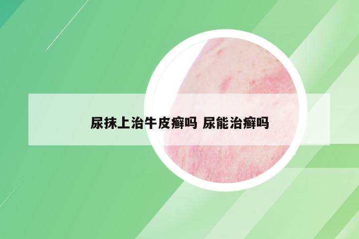 尿抹上治牛皮癣吗 尿能治癣吗