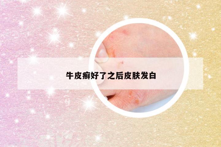 牛皮癣好了之后皮肤发白