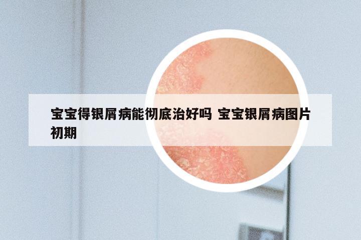 宝宝得银屑病能彻底治好吗 宝宝银屑病图片初期