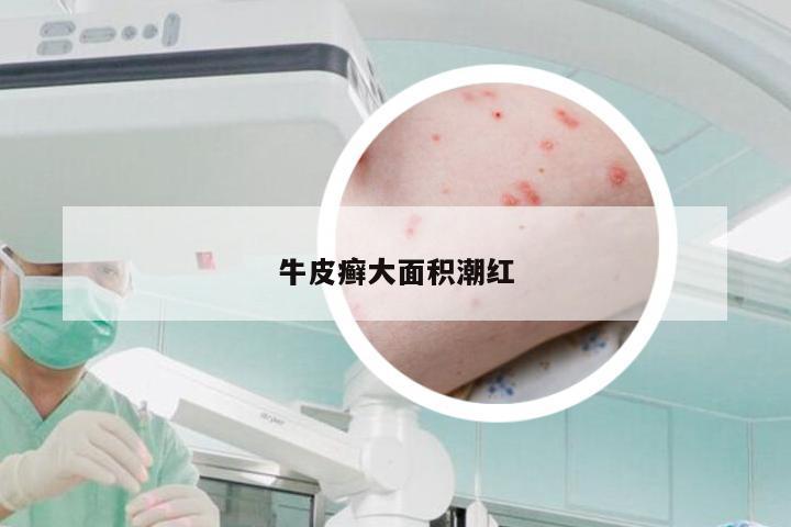 牛皮癣大面积潮红