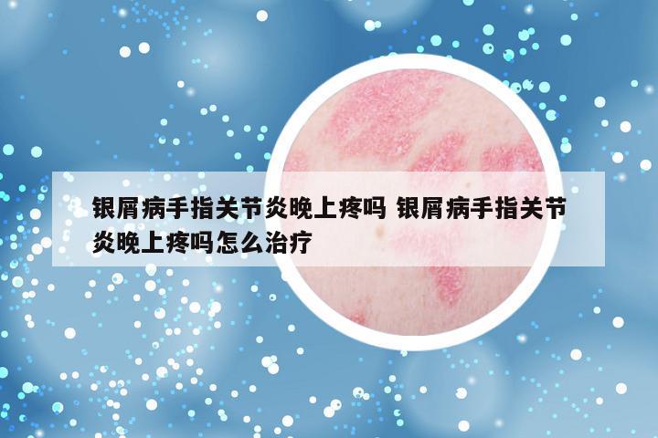 银屑病手指关节炎晚上疼吗 银屑病手指关节炎晚上疼吗怎么治疗