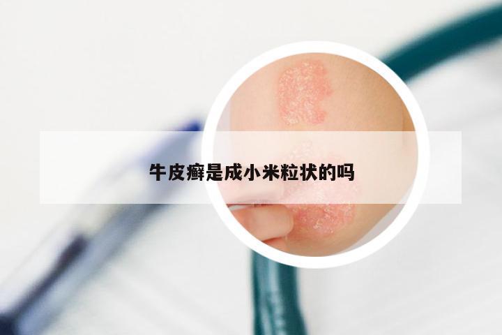 牛皮癣是成小米粒状的吗