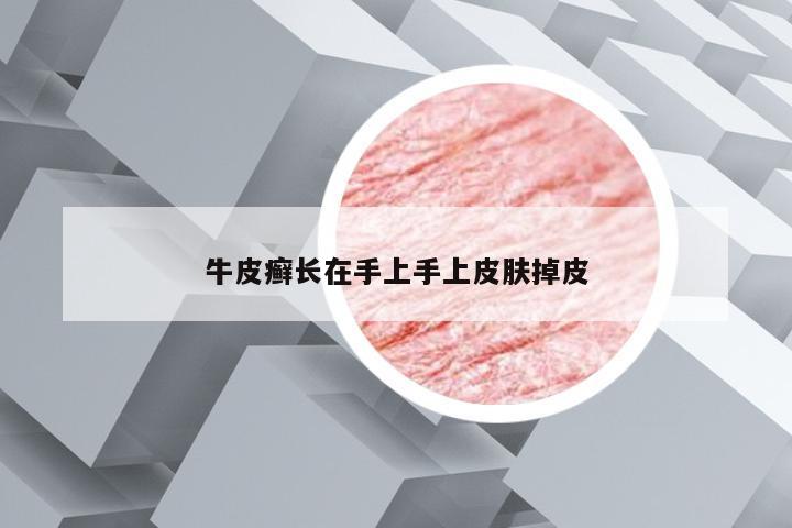 牛皮癣长在手上手上皮肤掉皮