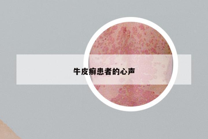 牛皮癣患者的心声