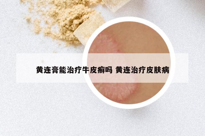 黄连膏能治疗牛皮癣吗 黄连治疗皮肤病