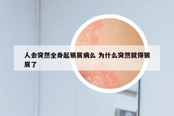 人会突然全身起银屑病么 为什么突然就得银屑了