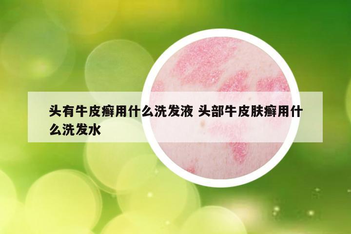 头有牛皮癣用什么洗发液 头部牛皮肤癣用什么洗发水