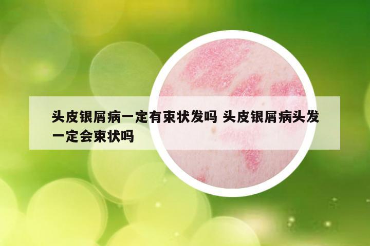 头皮银屑病一定有束状发吗 头皮银屑病头发一定会束状吗
