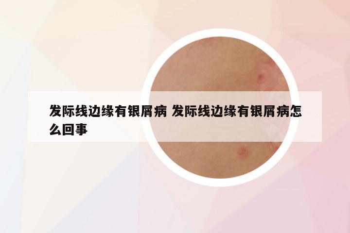 发际线边缘有银屑病 发际线边缘有银屑病怎么回事