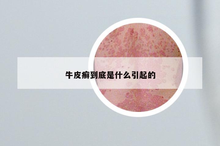 牛皮癣到底是什么引起的
