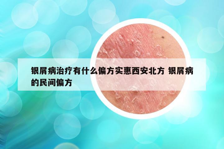 银屑病治疗有什么偏方实惠西安北方 银屑病的民间偏方