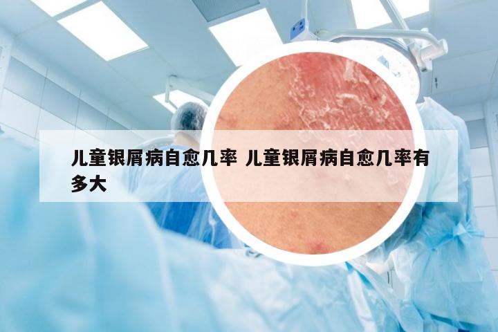 儿童银屑病自愈几率 儿童银屑病自愈几率有多大