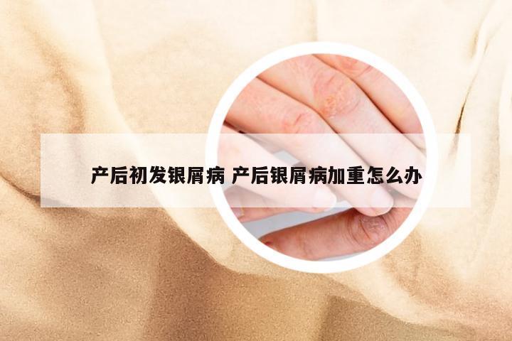产后初发银屑病 产后银屑病加重怎么办