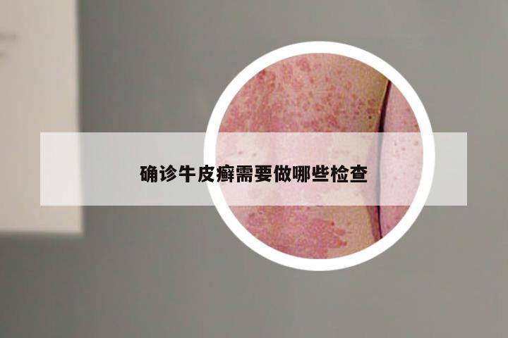 确诊牛皮癣需要做哪些检查