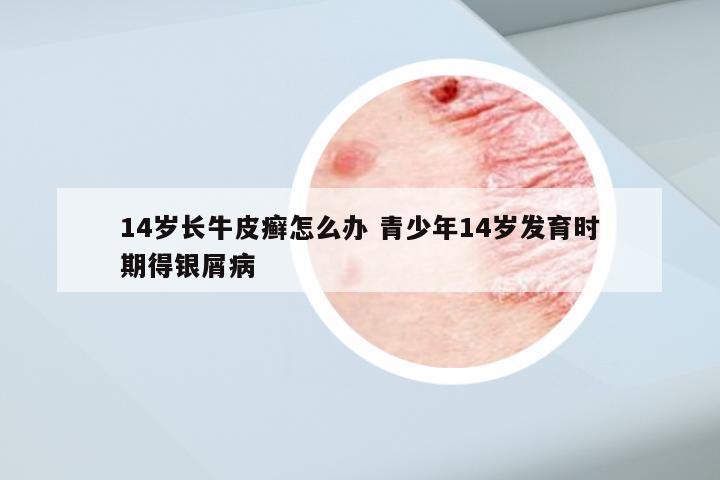 14岁长牛皮癣怎么办 青少年14岁发育时期得银屑病