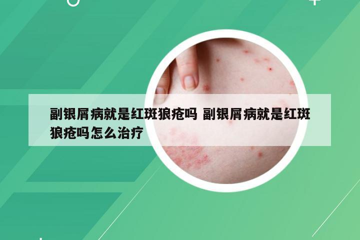 副银屑病就是红斑狼疮吗 副银屑病就是红斑狼疮吗怎么治疗