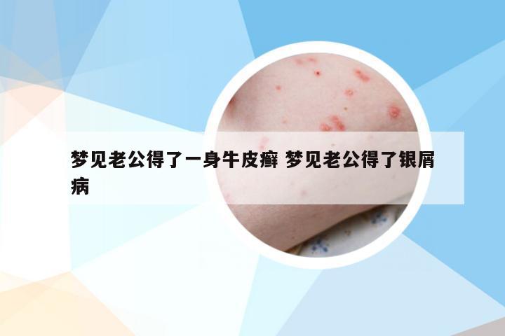 梦见老公得了一身牛皮癣 梦见老公得了银屑病