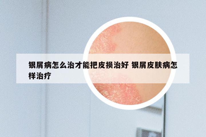 银屑病怎么治才能把皮损治好 银屑皮肤病怎样治疗