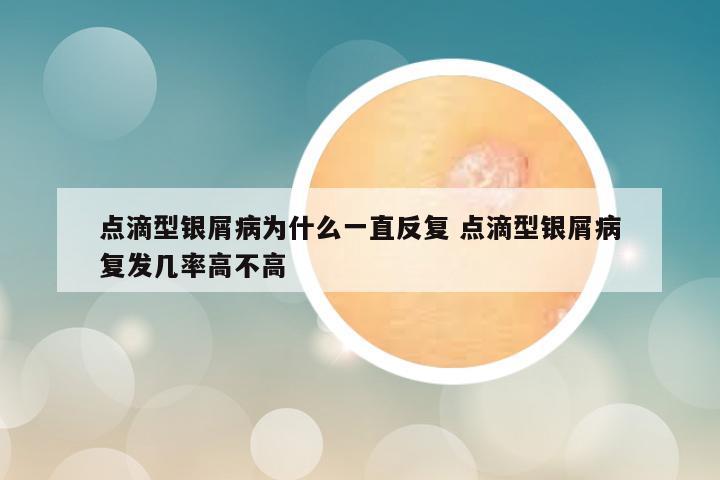 点滴型银屑病为什么一直反复 点滴型银屑病复发几率高不高