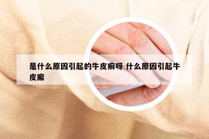是什么原因引起的牛皮癣呀 什么原因引起牛皮廨