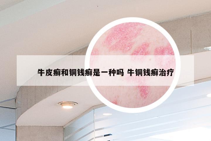 牛皮癣和铜钱癣是一种吗 牛铜钱癣治疗