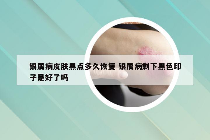 银屑病皮肤黑点多久恢复 银屑病剩下黑色印子是好了吗