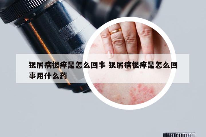 银屑病很痒是怎么回事 银屑病很痒是怎么回事用什么药