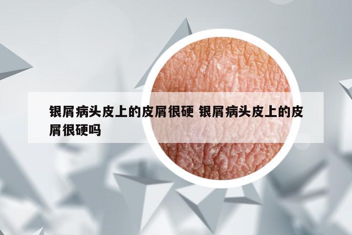银屑病头皮上的皮屑很硬 银屑病头皮上的皮屑很硬吗