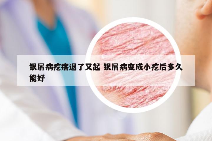 银屑病疙瘩退了又起 银屑病变成小疙后多久能好