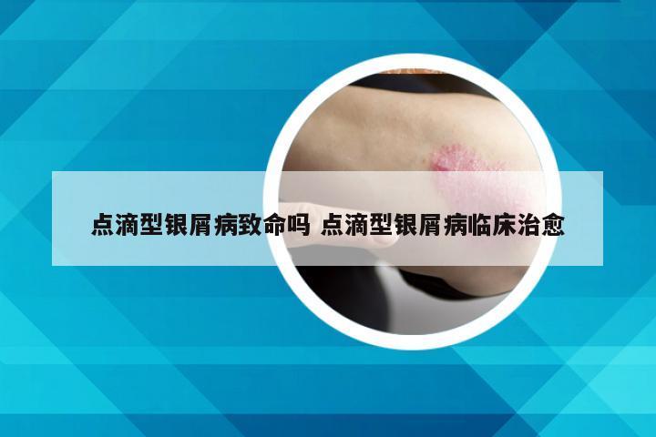 点滴型银屑病致命吗 点滴型银屑病临床治愈