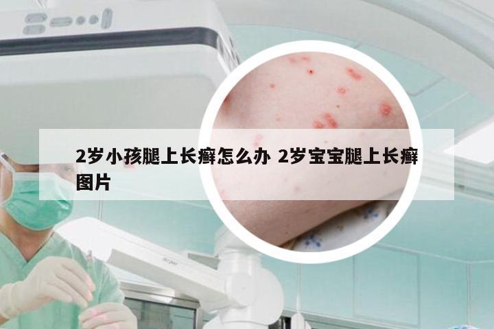 2岁小孩腿上长癣怎么办 2岁宝宝腿上长癣图片