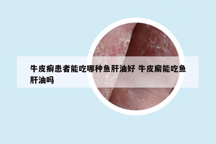 牛皮癣患者能吃哪种鱼肝油好 牛皮廨能吃鱼肝油吗