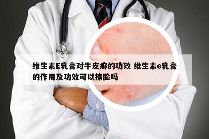 维生素E乳膏对牛皮癣的功效 维生素e乳膏的作用及功效可以擦脸吗