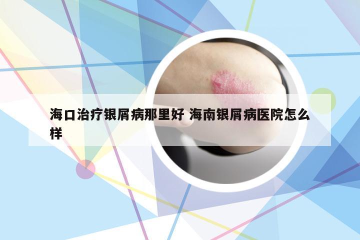 海口治疗银屑病那里好 海南银屑病医院怎么样