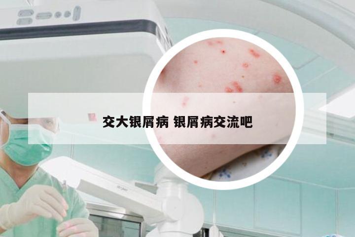 交大银屑病 银屑病交流吧