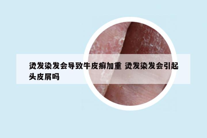 烫发染发会导致牛皮癣加重 烫发染发会引起头皮屑吗
