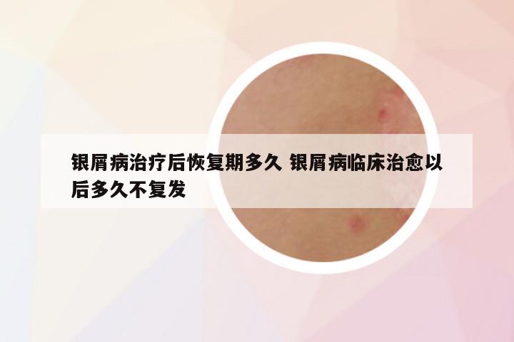 银屑病治疗后恢复期多久 银屑病临床治愈以后多久不复发