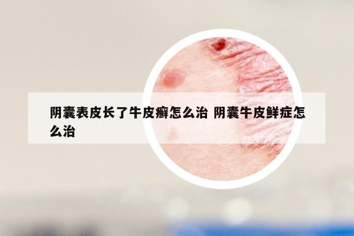 阴囊表皮长了牛皮癣怎么治 阴囊牛皮鲜症怎么治