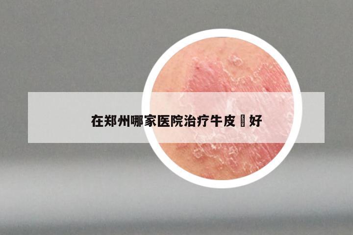 在郑州哪家医院治疗牛皮廯好