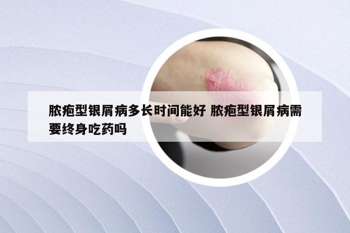 脓疱型银屑病多长时间能好 脓疱型银屑病需要终身吃药吗