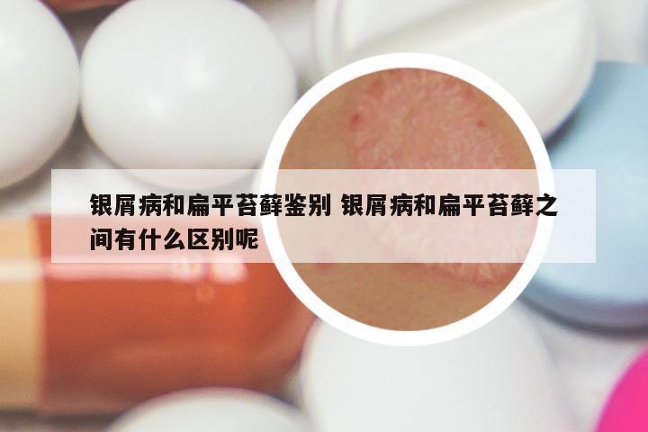 银屑病和扁平苔藓鉴别 银屑病和扁平苔藓之间有什么区别呢